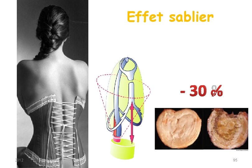 Effet sablier - 30 % 2012 95 