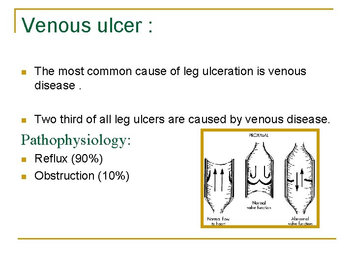 Venous ulcer : n The most common cause of leg ulceration is venous disease.