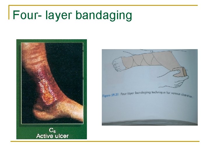 Four- layer bandaging 