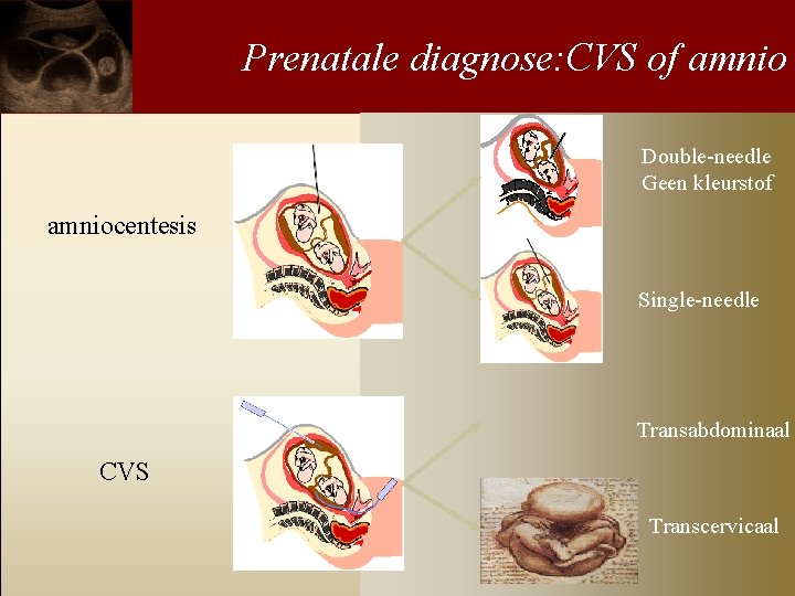 Prenatale diagnose: CVS of amnio Double-needle Geen kleurstof amniocentesis Single-needle Transabdominaal CVS Transcervicaal 