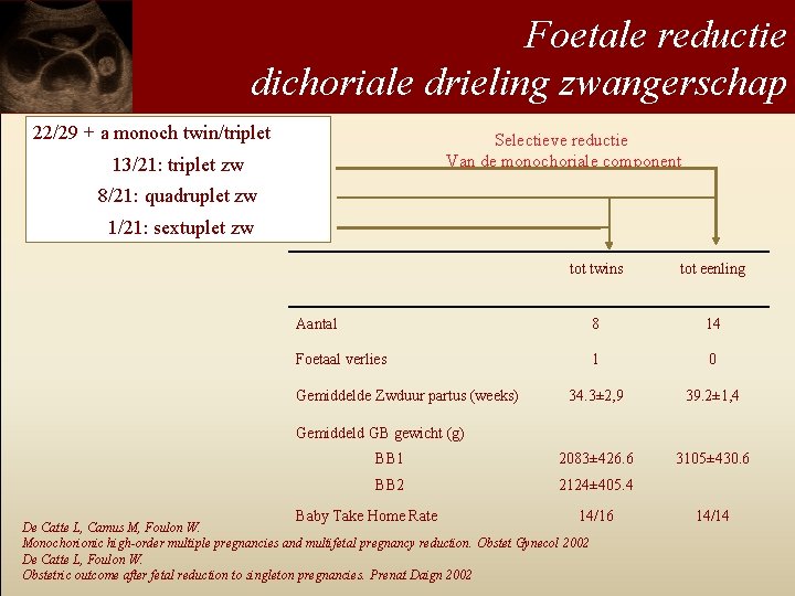 Foetale reductie dichoriale drieling zwangerschap 22/29 + a monoch twin/triplet Selectieve reductie Van de