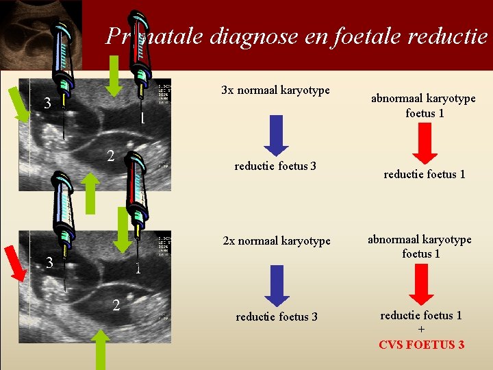 Prenatale diagnose en foetale reductie 3 x normaal karyotype 3 1 2 3 reductie