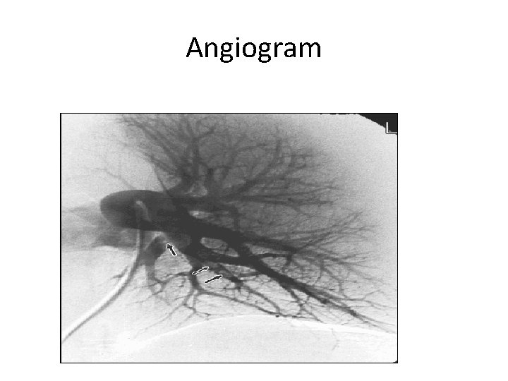 Angiogram 