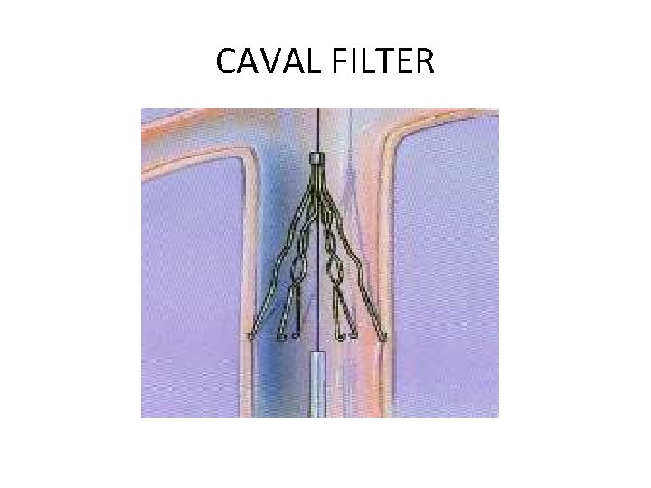 CAVAL FILTER 