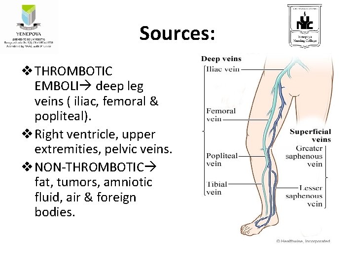 Sources: v THROMBOTIC EMBOLI deep leg veins ( iliac, femoral & popliteal). v Right