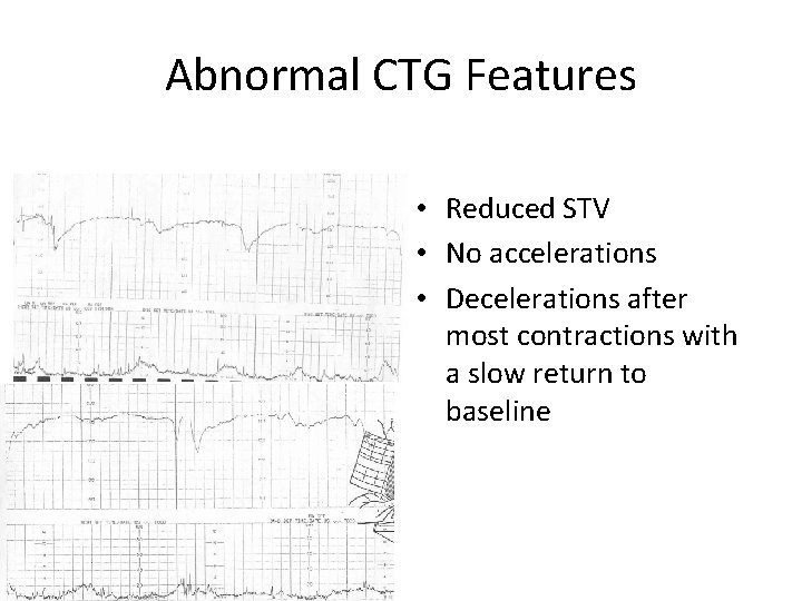 Abnormal CTG Features • Reduced STV • No accelerations • Decelerations after most contractions