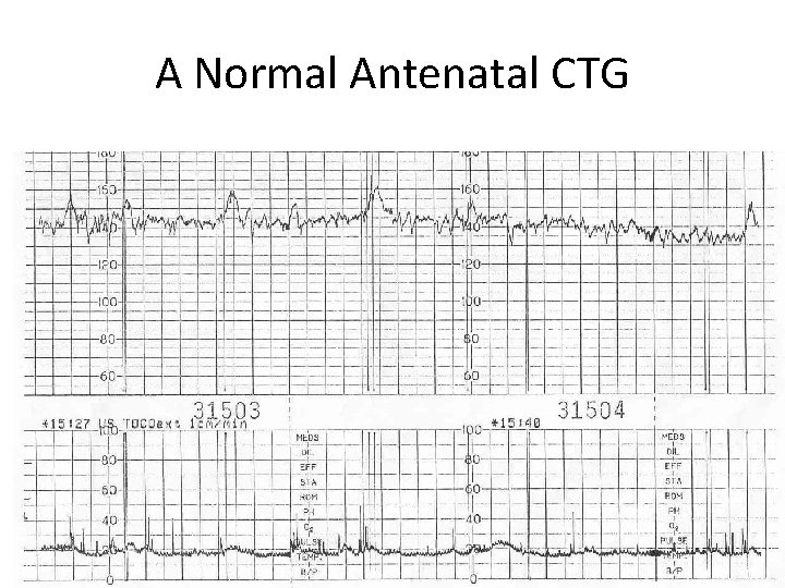 A Normal Antenatal CTG 