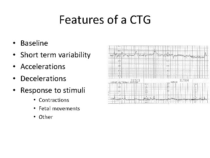 Features of a CTG • • • Baseline Short term variability Accelerations Decelerations Response