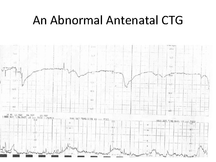 An Abnormal Antenatal CTG 