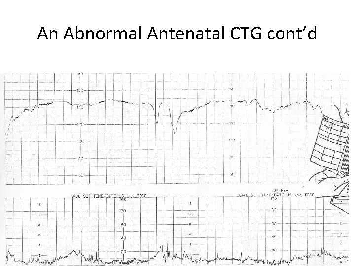 An Abnormal Antenatal CTG cont’d 