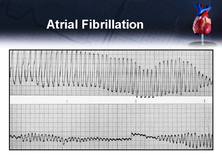 Atrial Fibrillation 
