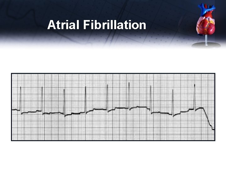 Atrial Fibrillation 