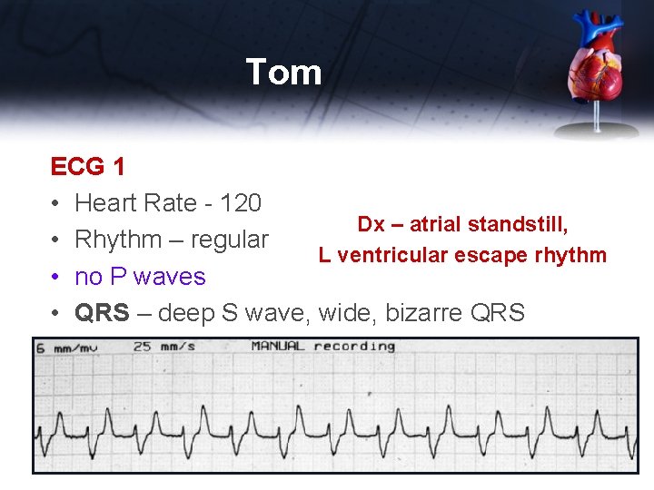 Tom ECG 1 • Heart Rate - 120 Dx – atrial standstill, • Rhythm