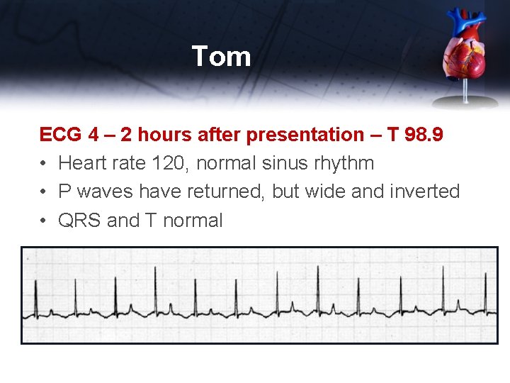 Tom ECG 4 – 2 hours after presentation – T 98. 9 • Heart
