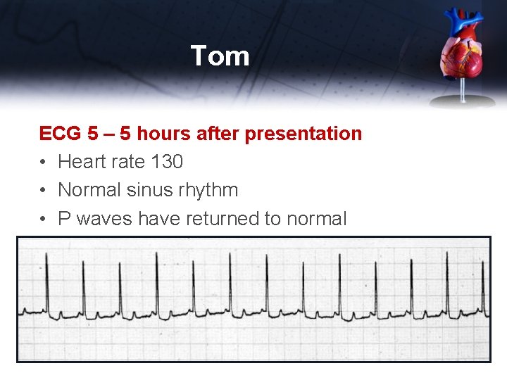 Tom ECG 5 – 5 hours after presentation • Heart rate 130 • Normal