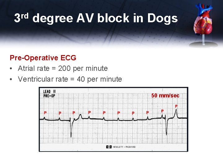 3 rd degree AV block in Dogs Pre-Operative ECG • Atrial rate = 200