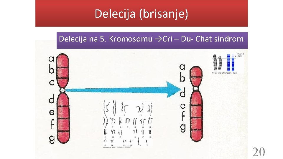 Delecija (brisanje) Delecija na 5. Kromosomu →Cri – Du- Chat sindrom 20 