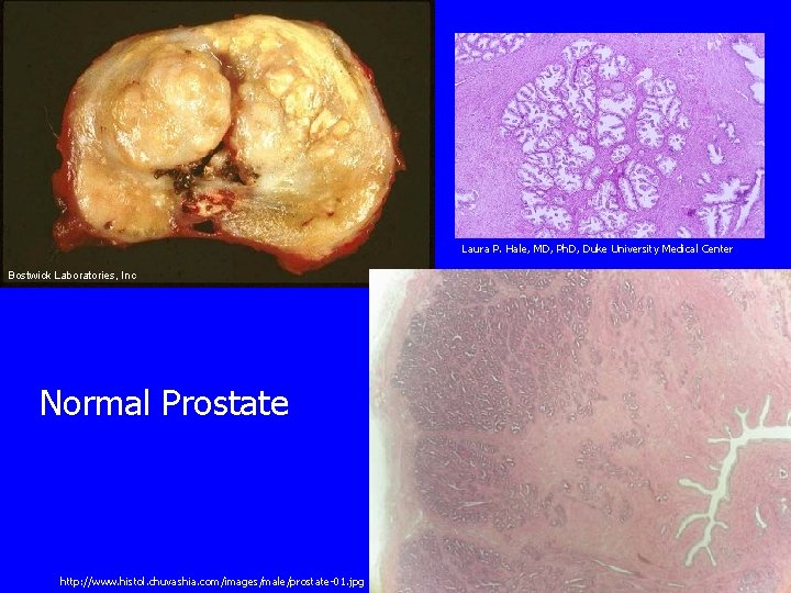 Laura P. Hale, MD, Ph. D, Duke University Medical Center Bostwick Laboratories, Inc Normal