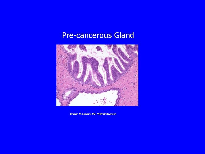 Pre-cancerous Gland Dharam M. Ramnani, MD; Web. Pathology. com 