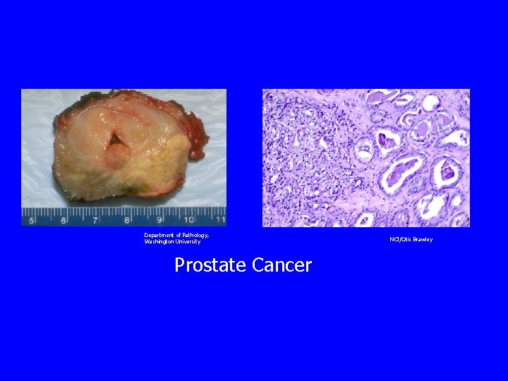 Department of Pathology, Washington University Prostate Cancer NCI/Otis Brawley 