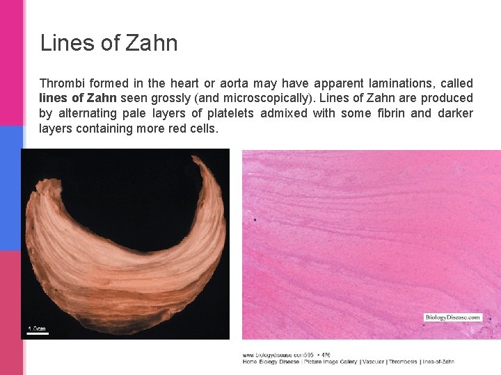 Lines of Zahn Thrombi formed in the heart or aorta may have apparent laminations,