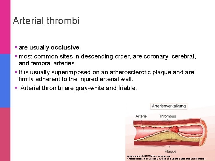 Arterial thrombi § are usually occlusive § most common sites in descending order, are