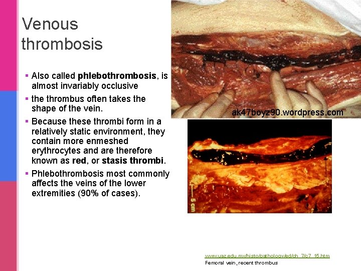 Venous thrombosis § Also called phlebothrombosis, is almost invariably occlusive § the thrombus often