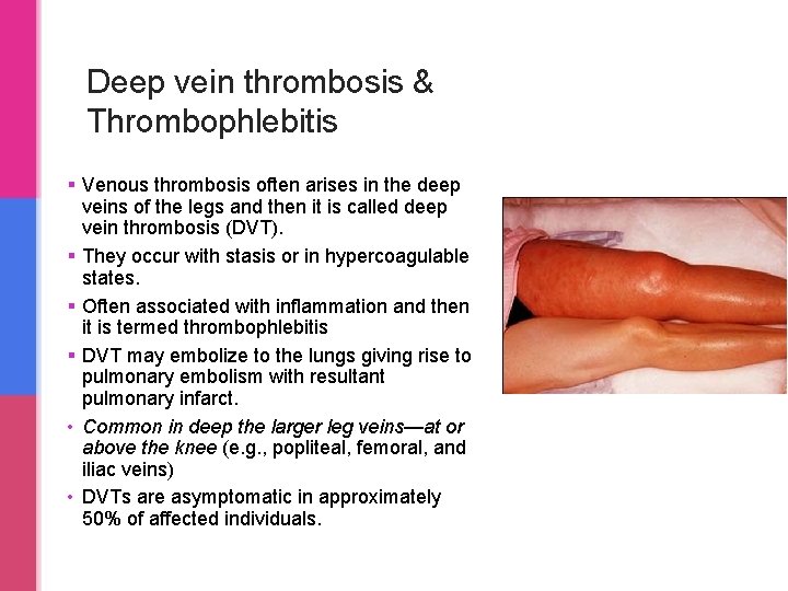 Deep vein thrombosis & Thrombophlebitis § Venous thrombosis often arises in the deep veins