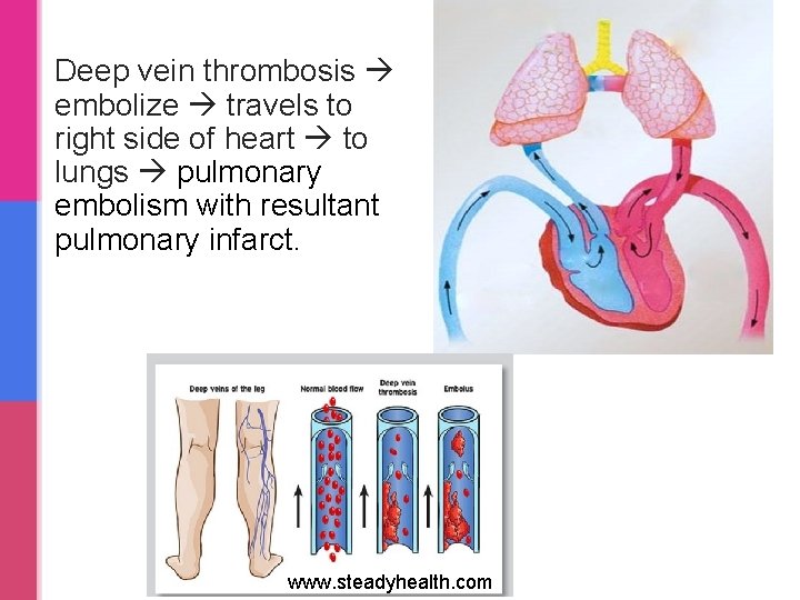 Deep vein thrombosis embolize travels to right side of heart to lungs pulmonary embolism