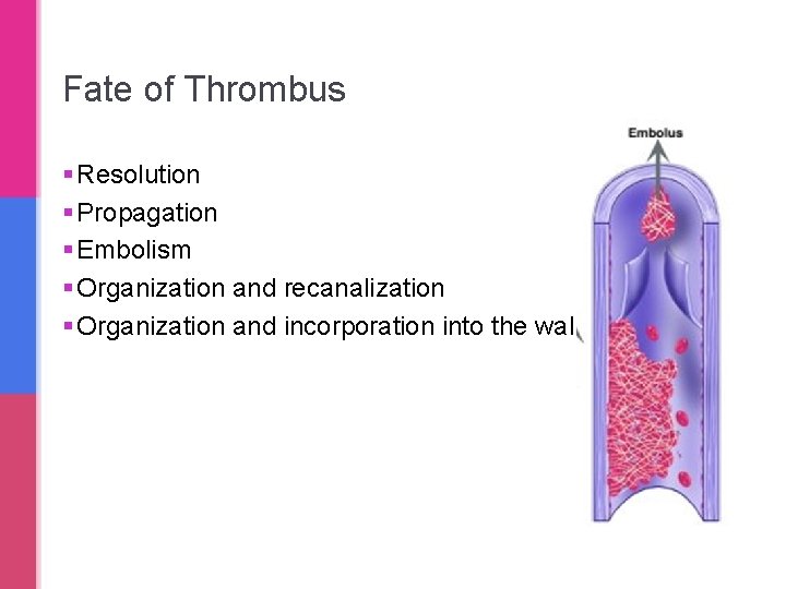 Fate of Thrombus § Resolution § Propagation § Embolism § Organization and recanalization §