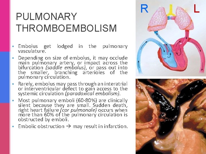 PULMONARY THROMBOEMBOLISM • Embolus get lodged in the pulmonary vasculature. • Depending on size