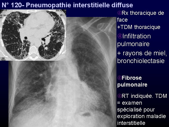N° 120 - Pneumopathie interstitielle diffuse Rx thoracique de face +TDM thoracique Infiltration pulmonaire