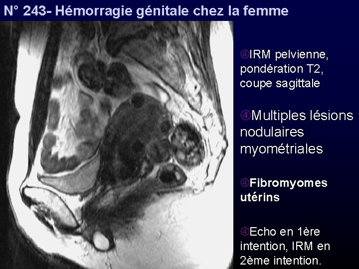 N° 243 - Hémorragie génitale chez la femme IRM pelvienne, pondération T 2, coupe