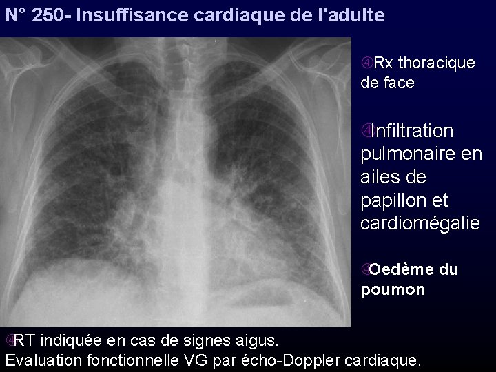 N° 250 - Insuffisance cardiaque de l'adulte Rx thoracique de face Infiltration pulmonaire en