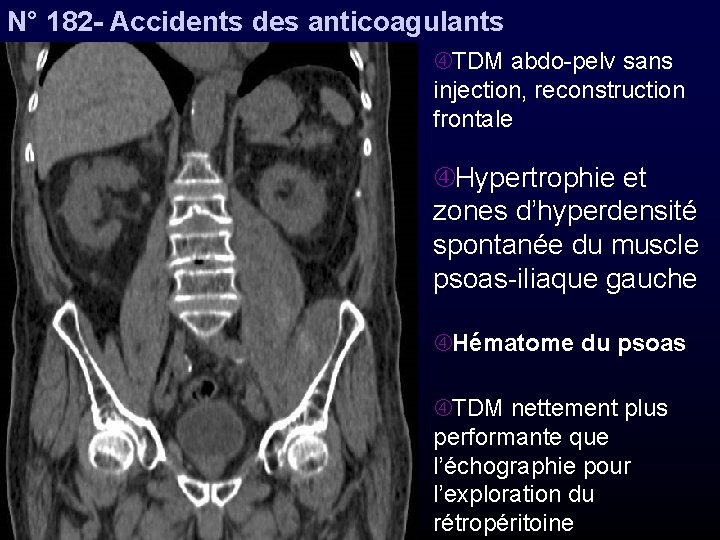 N° 182 - Accidents des anticoagulants TDM abdo-pelv sans injection, reconstruction frontale Hypertrophie et