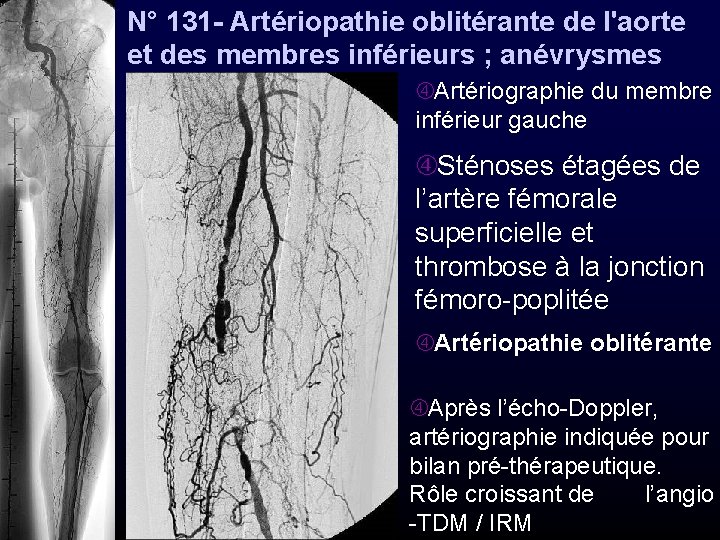 N° 131 - Artériopathie oblitérante de l'aorte et des membres inférieurs ; anévrysmes Artériographie