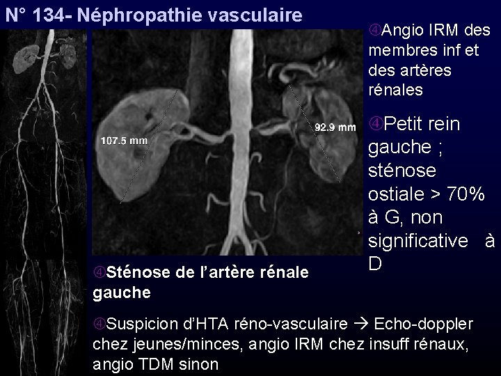 N° 134 - Néphropathie vasculaire Sténose de l’artère rénale gauche Angio IRM des membres