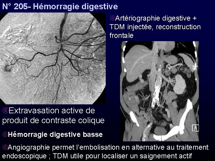 N° 205 - Hémorragie digestive Artériographie digestive + TDM injectée, reconstruction frontale Extravasation active