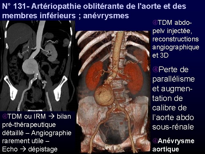 N° 131 - Artériopathie oblitérante de l'aorte et des membres inférieurs ; anévrysmes TDM