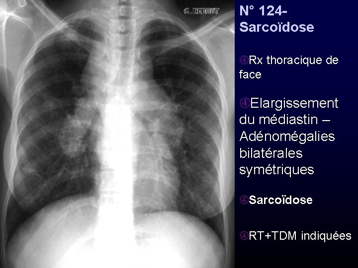 N° 124 - Sarcoïdose Rx thoracique de face Elargissement du médiastin – Adénomégalies bilatérales