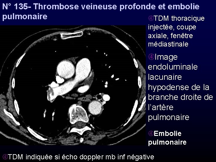 N° 135 - Thrombose veineuse profonde et embolie pulmonaire TDM thoracique injectée, coupe axiale,
