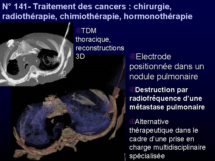 N° 141 - Traitement des cancers : chirurgie, radiothérapie, chimiothérapie, hormonothérapie TDM thoracique, reconstructions