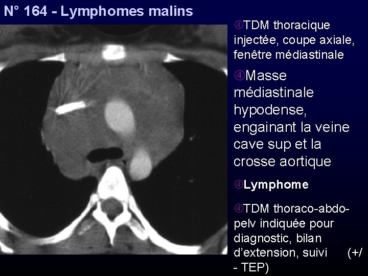 N° 164 - Lymphomes malins TDM thoracique injectée, coupe axiale, fenêtre médiastinale Masse médiastinale