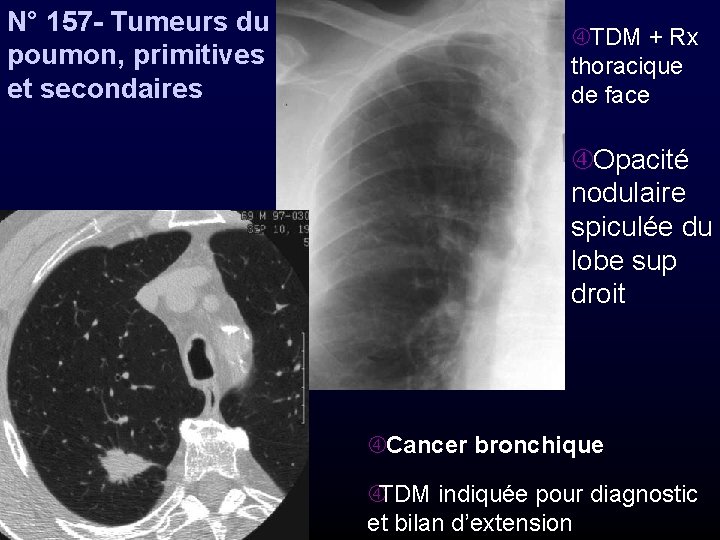 N° 157 - Tumeurs du poumon, primitives et secondaires TDM + Rx thoracique de