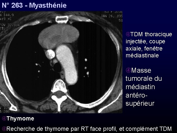 N° 263 - Myasthénie TDM thoracique injectée, coupe axiale, fenêtre médiastinale Masse tumorale du