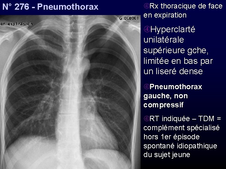N° 276 - Pneumothorax Rx thoracique de face en expiration Hyperclarté unilatérale supérieure gche,