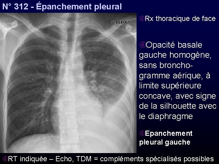 N° 312 - Épanchement pleural Rx thoracique de face Opacité basale gauche homogène, sans