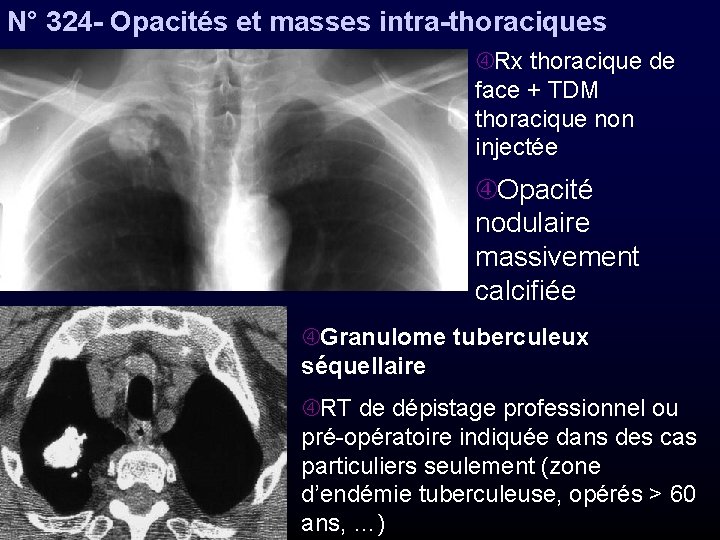 N° 324 - Opacités et masses intra-thoraciques Rx thoracique de face + TDM thoracique
