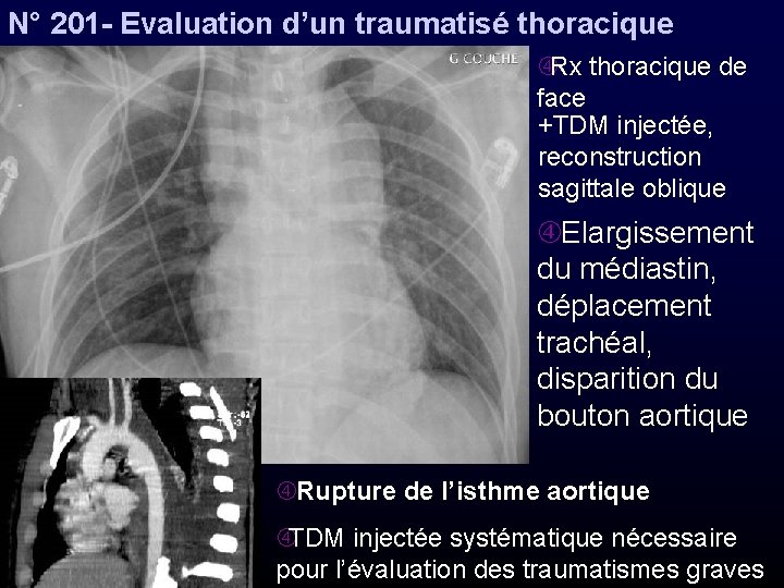 N° 201 - Evaluation d’un traumatisé thoracique Rx thoracique de face +TDM injectée, reconstruction