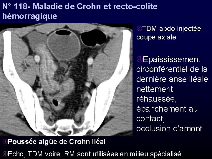 N° 118 - Maladie de Crohn et recto-colite hémorragique TDM abdo injectée, coupe axiale